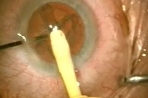 Grauer Star – Augenärztliche Gemeinschaftspraxis | Dr. Heuring, Dr. Jung & Kollegen