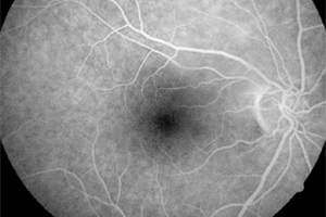 Fluoreszeinangiographie – Augenärztliche Gemeinschaftspraxis | Dr. Heuring, Dr. Jung & Kollegen