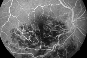 Fluoreszeinangiographie – Augenärztliche Gemeinschaftspraxis | Dr. Heuring, Dr. Jung & Kollegen