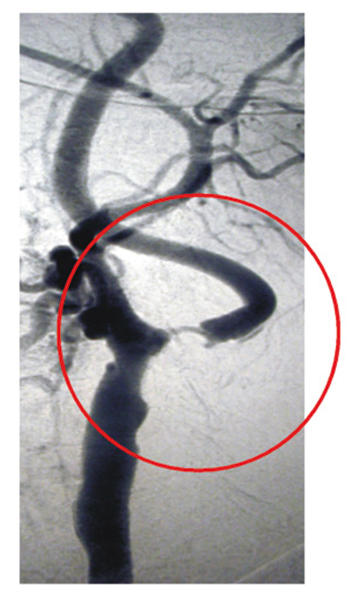 Schlaganfallprophylaxe – Augenärztliche Gemeinschaftspraxis | Dr. Heuring, Dr. Jung & Kollegen