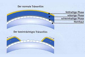 Trockene Augen – Augenärztliche Gemeinschaftspraxis | Dr. Heuring, Dr. Jung & Kollegen